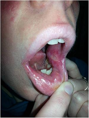 Recurrent, Severe Aphthous Stomatitis and Mucosal Ulcers as Primary Manifestations of a Novel STAT1 <mark class="highlighted">Gain-of-Function Mutation</mark>